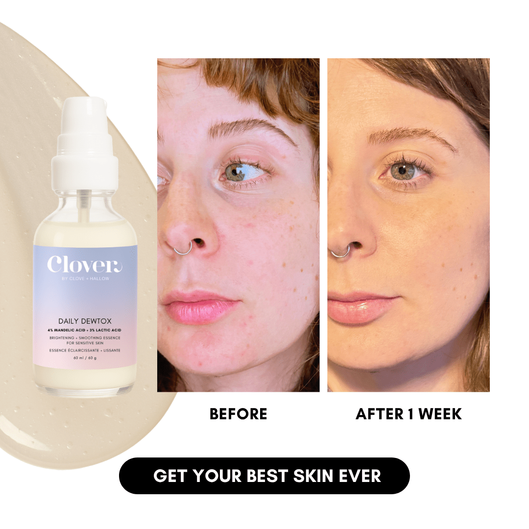 Clover by Clove + Hallow Skincare Daily Dewtox Smoothing & Brightening Essence Affordable Acne Skin Care | Balancing Oil